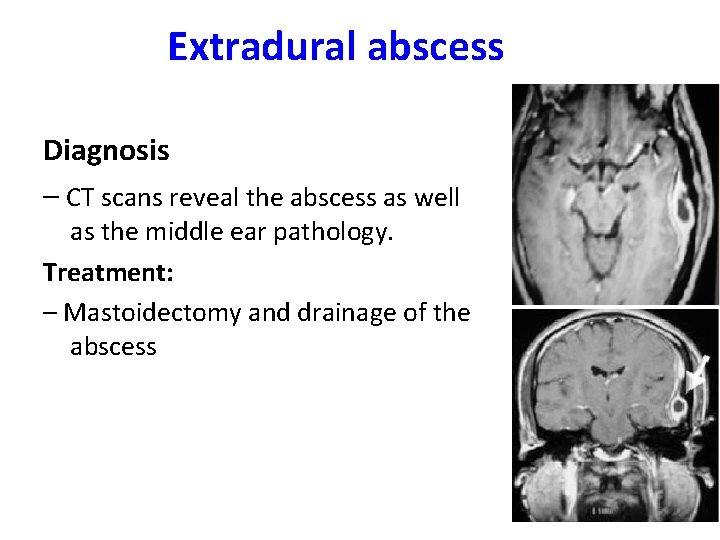 Extradural abscess Diagnosis – CT scans reveal the abscess as well as the middle