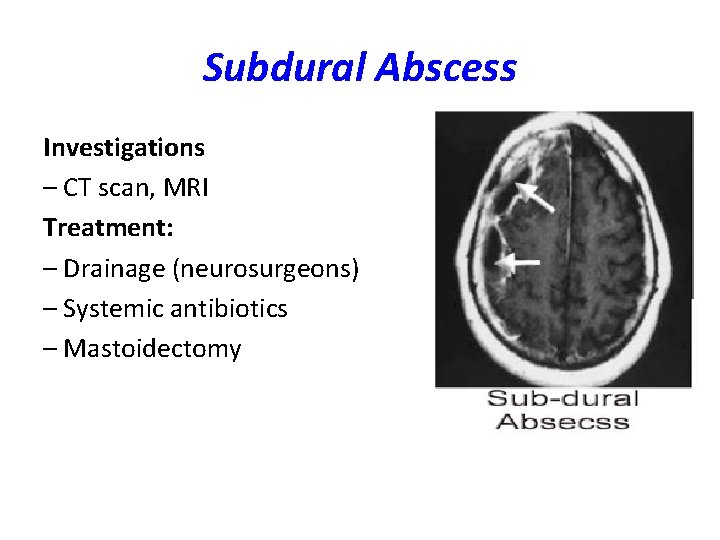 Subdural Abscess Investigations – CT scan, MRI Treatment: – Drainage (neurosurgeons) – Systemic antibiotics