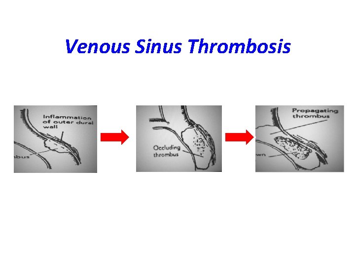 Venous Sinus Thrombosis 