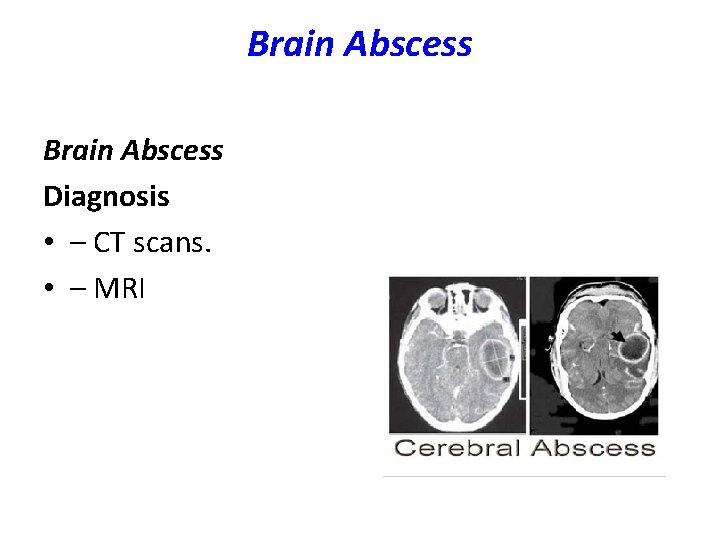 Brain Abscess Diagnosis • – CT scans. • – MRI 