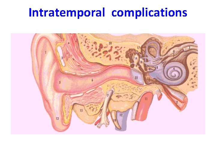 Intratemporal complications 