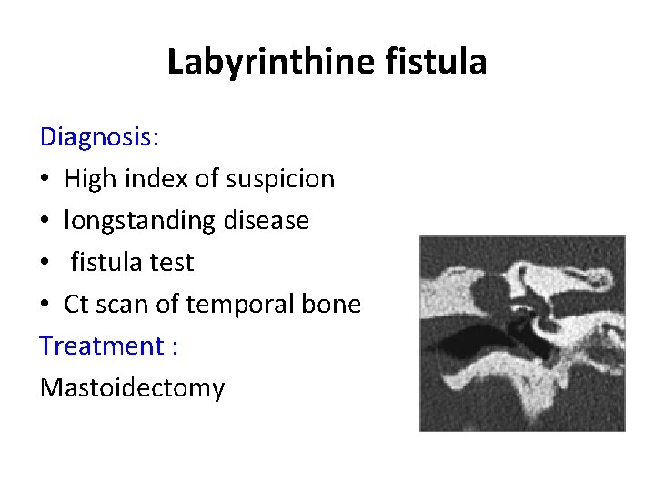 Labyrinthine fistula Diagnosis: • High index of suspicion • longstanding disease • fistula test