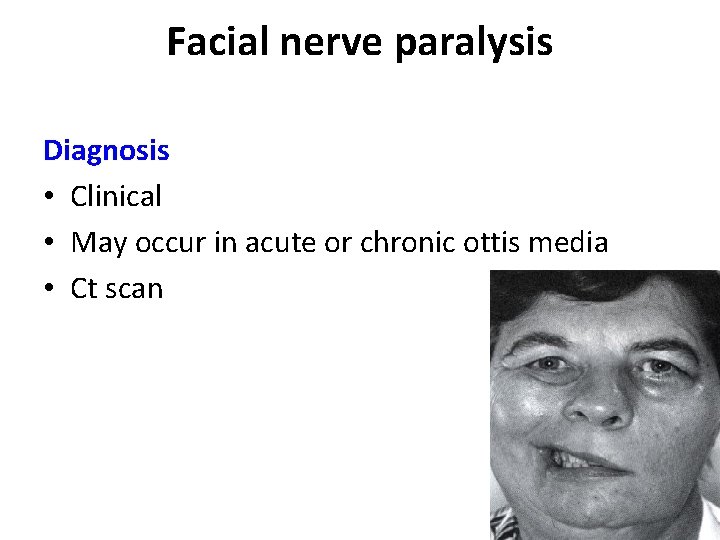 Facial nerve paralysis Diagnosis • Clinical • May occur in acute or chronic ottis