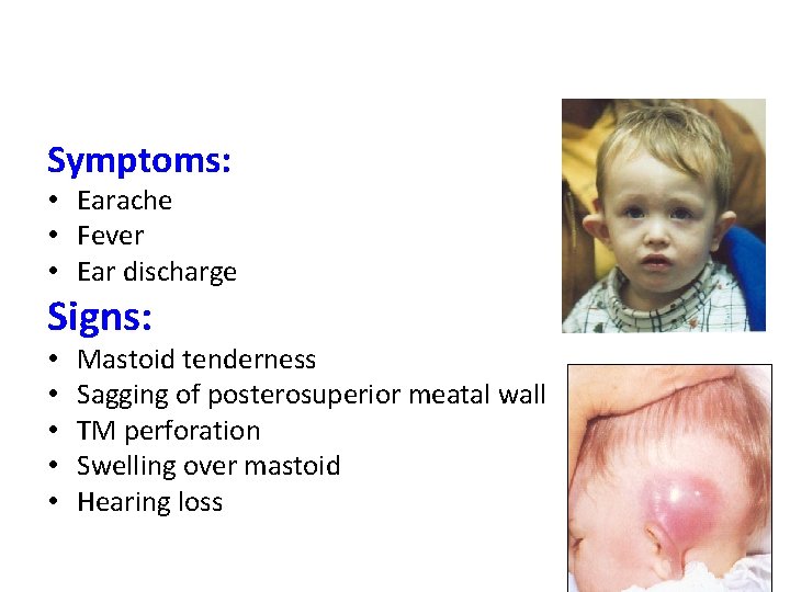 Symptoms: • Earache • Fever • Ear discharge Signs: • • • Mastoid tenderness