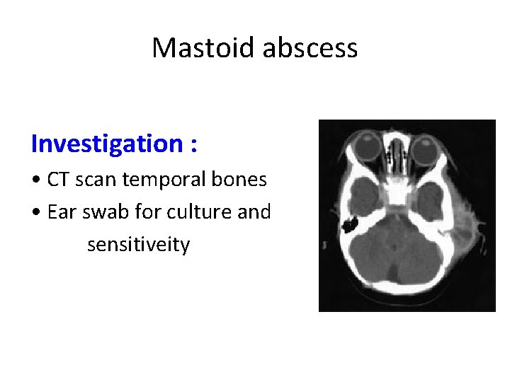 Mastoid abscess Investigation : • CT scan temporal bones • Ear swab for culture