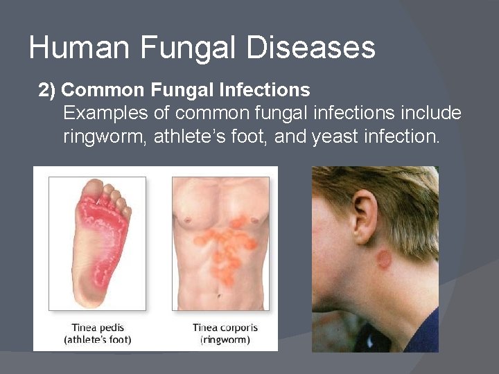 Human Fungal Diseases 2) Common Fungal Infections Examples of common fungal infections include ringworm,