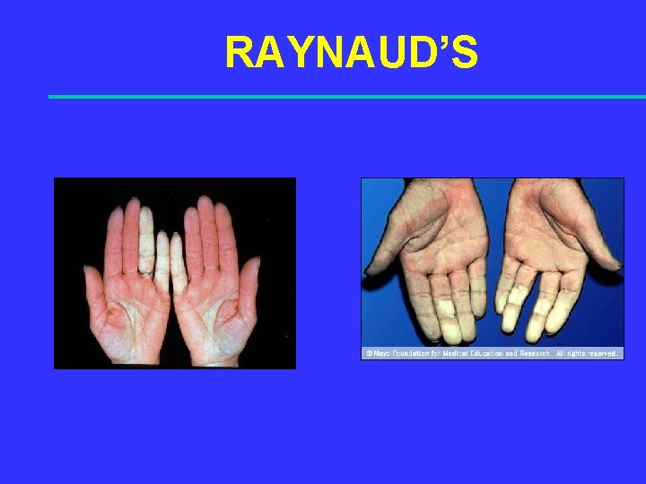 RAYNAUD’S 