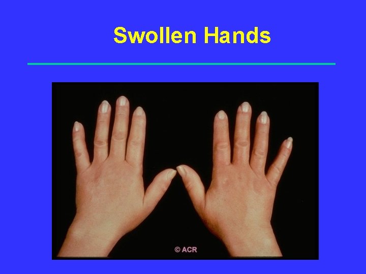 Swollen Hands 