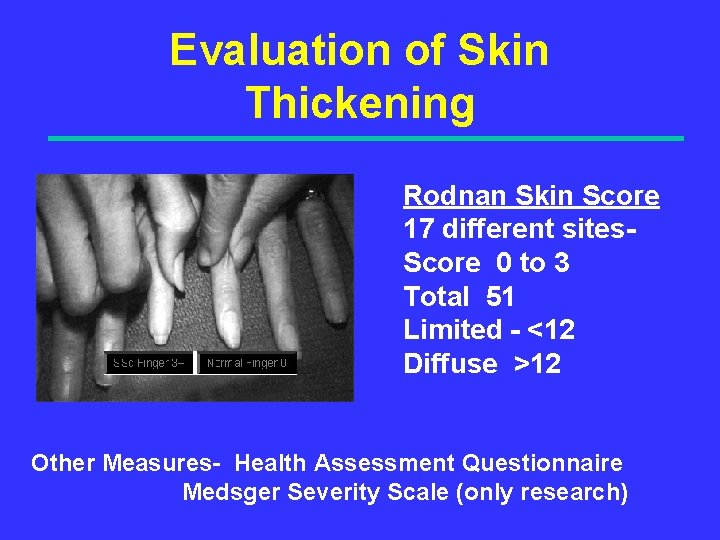 Evaluation of Skin Thickening Rodnan Skin Score 17 different sites. Score 0 to 3