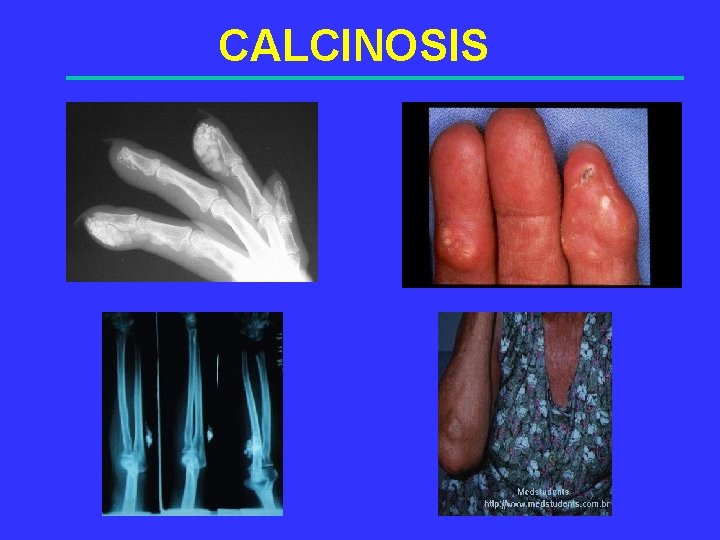 CALCINOSIS 