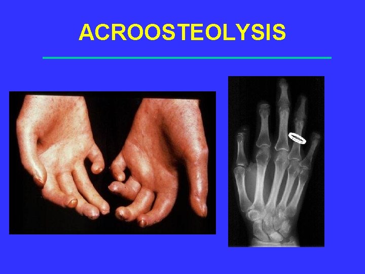 ACROOSTEOLYSIS 