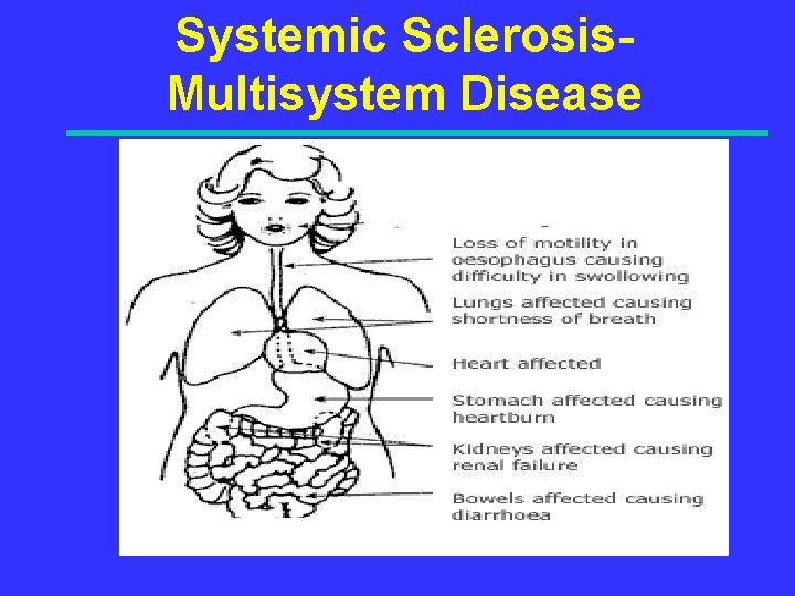 Systemic Sclerosis. Multisystem Disease 