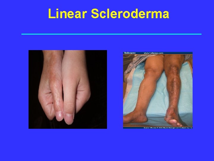 Linear Scleroderma Linear, single extremity Hyperpigmented, Muscle atrophy but normal strength 