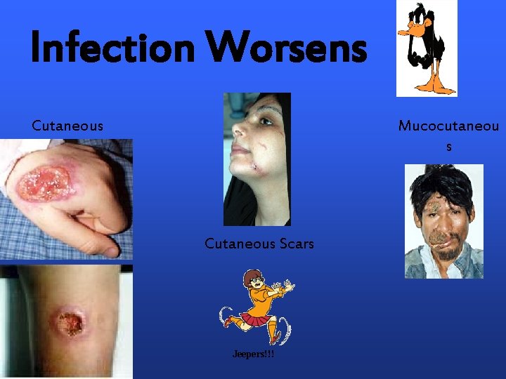 Infection Worsens Cutaneous Mucocutaneou s Cutaneous Scars Jeepers!!! 