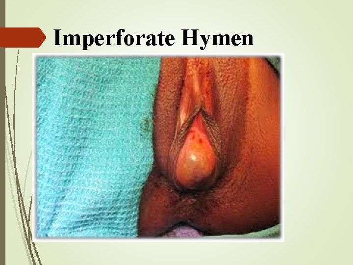 Imperforate Hymen 