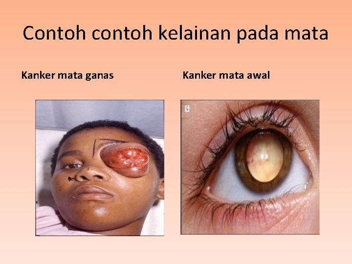 Contoh contoh kelainan pada mata Kanker mata ganas Kanker mata awal 