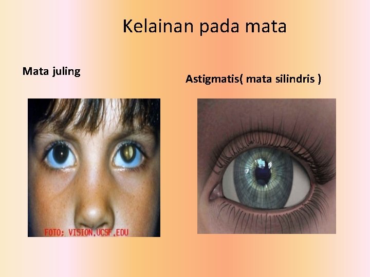 Kelainan pada mata Mata juling Astigmatis( mata silindris ) 