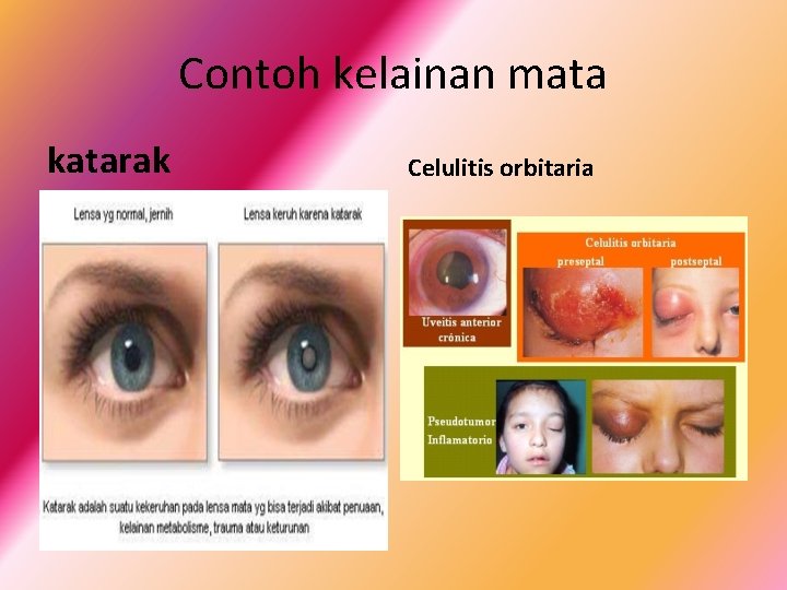 Contoh kelainan mata katarak Celulitis orbitaria 