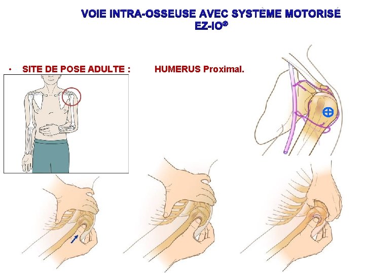 VOIE INTRA-OSSEUSE AVEC SYSTÈME MOTORISÉ EZ-IO® • SITE DE POSE ADULTE : HUMERUS Proximal.