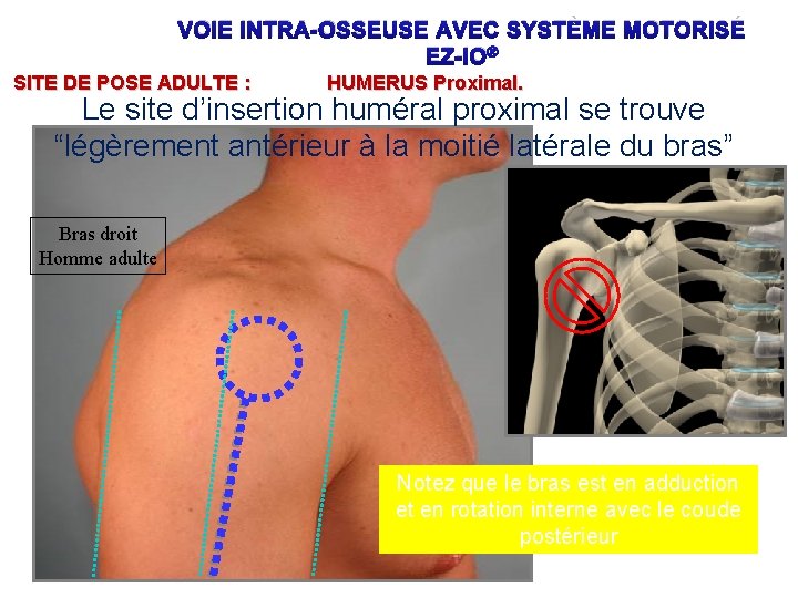 VOIE INTRA-OSSEUSE AVEC SYSTÈME MOTORISÉ EZ-IO® SITE DE POSE ADULTE : HUMERUS Proximal. Le