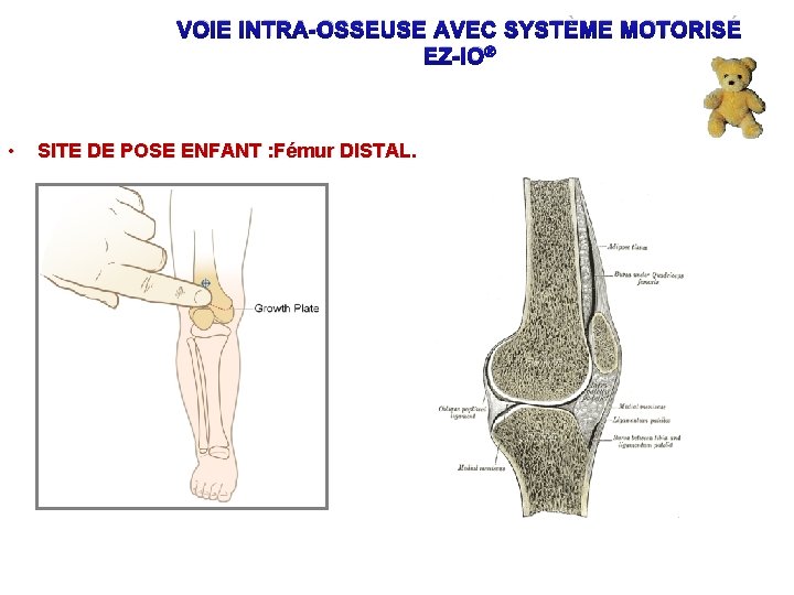 VOIE INTRA-OSSEUSE AVEC SYSTÈME MOTORISÉ EZ-IO® • SITE DE POSE ENFANT : Fémur DISTAL.