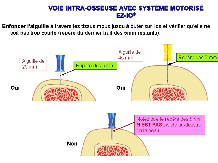 VOIE INTRA-OSSEUSE AVEC SYSTÈME MOTORISÉ EZ-IO® Enfoncer l'aiguille à travers les tissus mous jusqu'à