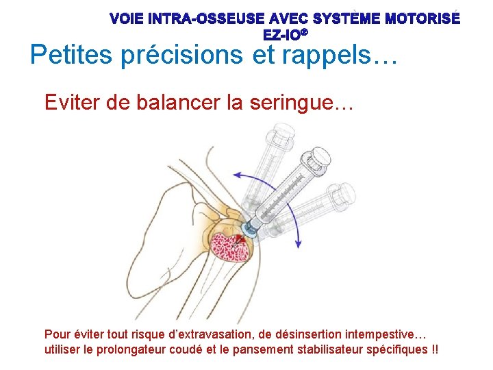 VOIE INTRA-OSSEUSE AVEC SYSTÈME MOTORISÉ EZ-IO® Petites précisions et rappels… Eviter de balancer la