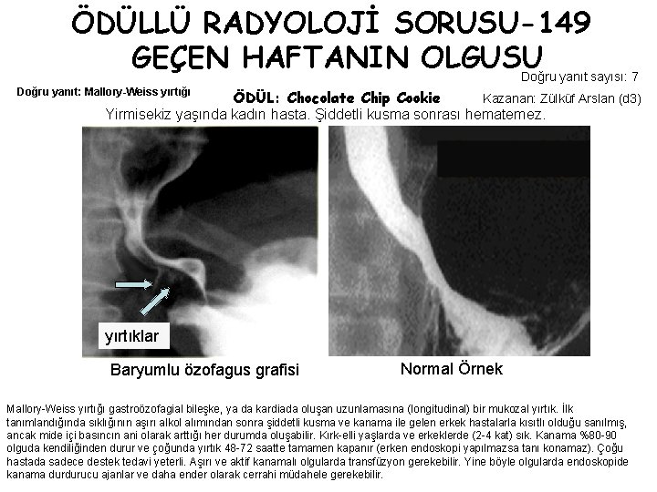 ÖDÜLLÜ RADYOLOJİ SORUSU-149 GEÇEN HAFTANIN OLGUSU Doğru yanıt sayısı: 7 Doğru yanıt: Mallory-Weiss yırtığı