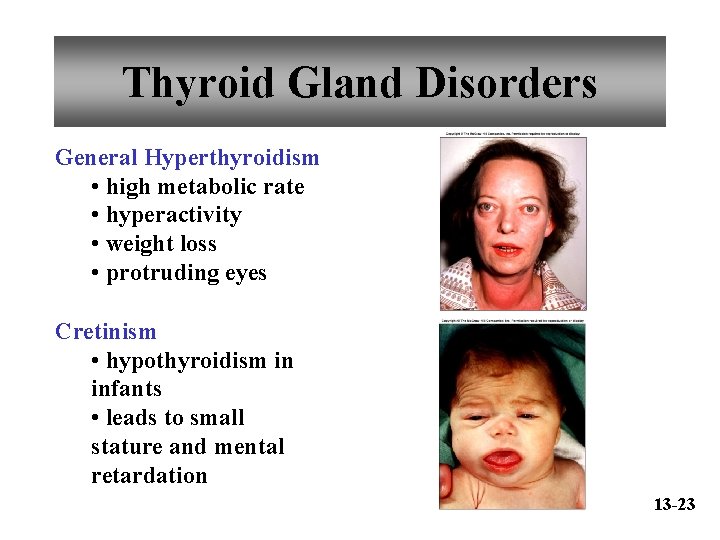 Thyroid Gland Disorders General Hyperthyroidism • high metabolic rate • hyperactivity • weight loss