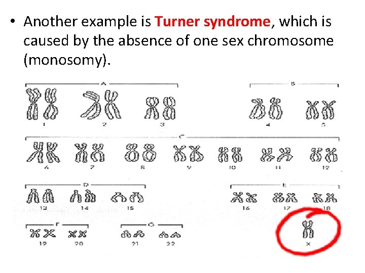  • Another example is Turner syndrome, which is caused by the absence of