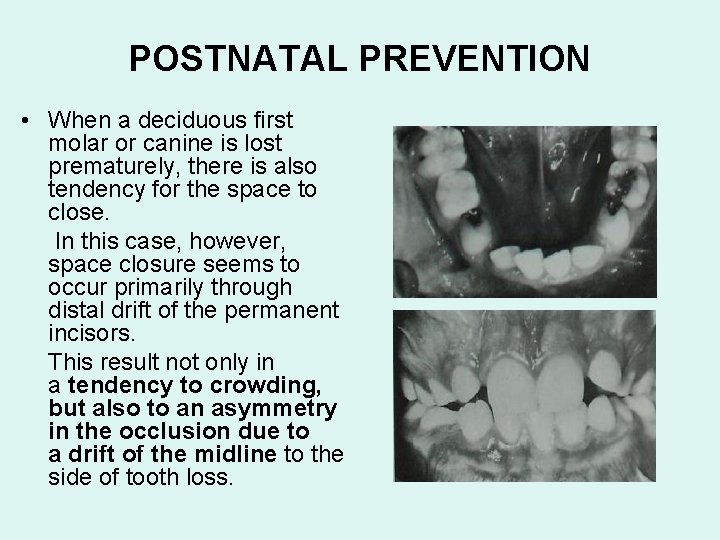 POSTNATAL PREVENTION • When a deciduous first molar or canine is lost prematurely, there