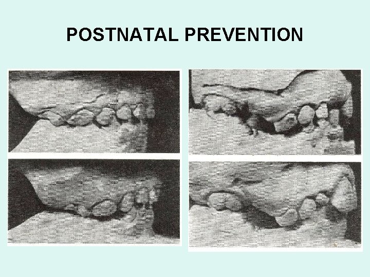 POSTNATAL PREVENTION 