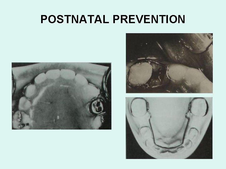 POSTNATAL PREVENTION 