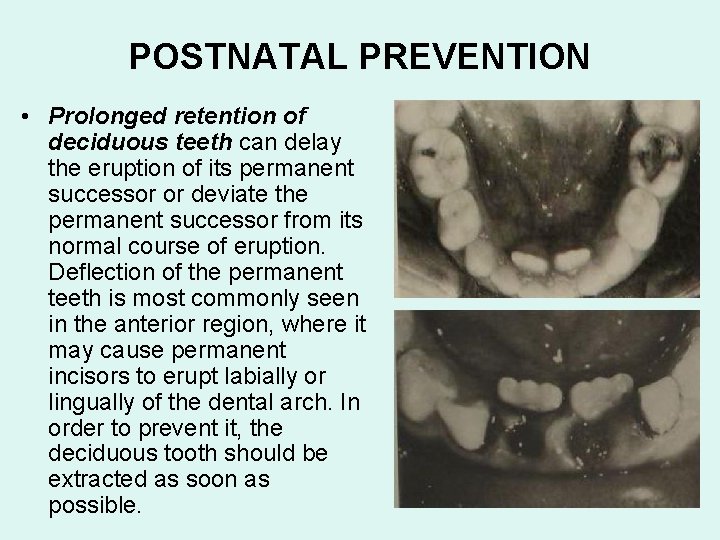 POSTNATAL PREVENTION • Prolonged retention of deciduous teeth can delay the eruption of its