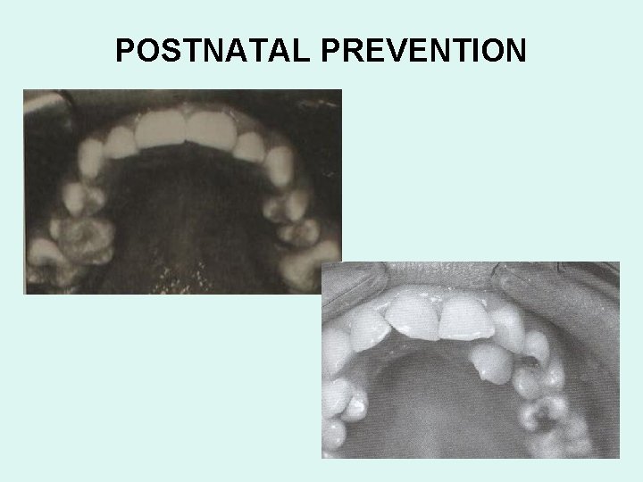 POSTNATAL PREVENTION 