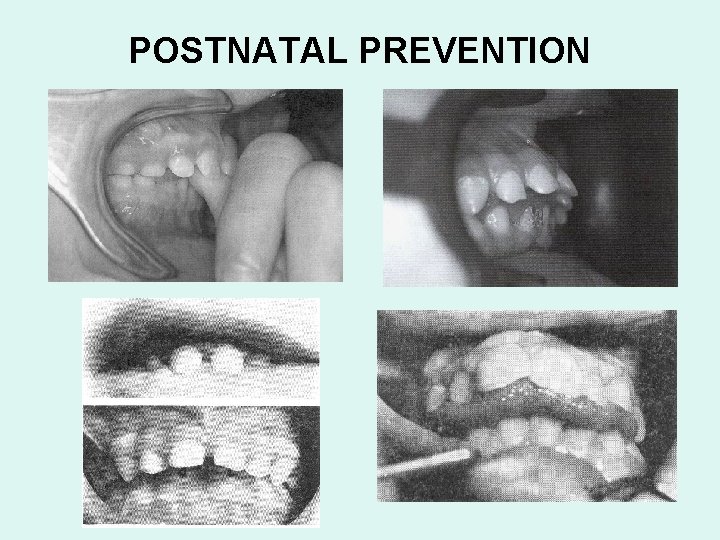 POSTNATAL PREVENTION 