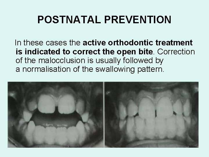 POSTNATAL PREVENTION In these cases the active orthodontic treatment is indicated to correct the