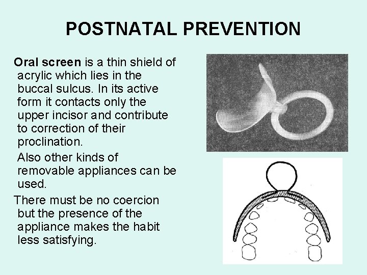 POSTNATAL PREVENTION Oral screen is a thin shield of acrylic which lies in the