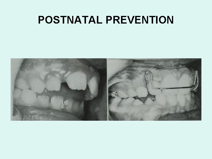 POSTNATAL PREVENTION 