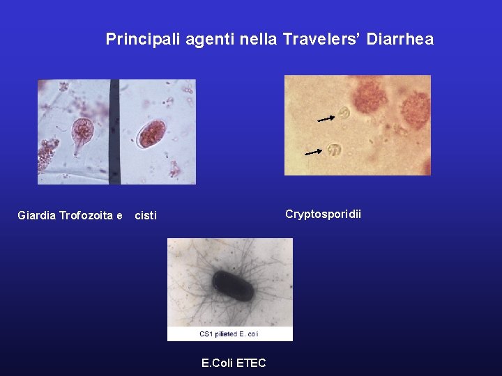 Principali agenti nella Travelers’ Diarrhea Giardia Trofozoita e Cryptosporidii cisti E. Coli ETEC 