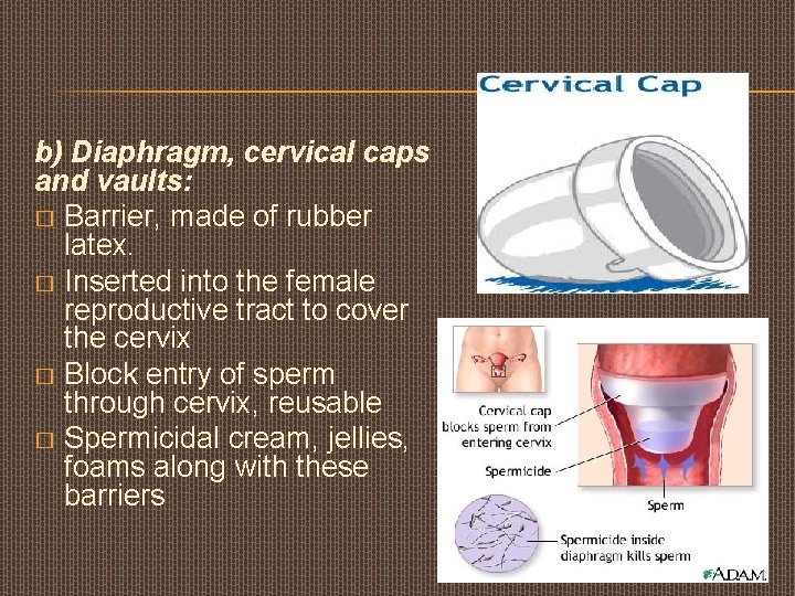 b) Diaphragm, cervical caps and vaults: � Barrier, made of rubber latex. � Inserted