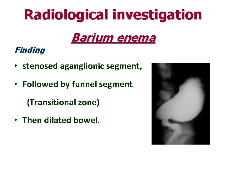 Radiological investigation Finding Barium enema • stenosed aganglionic segment, • Followed by funnel segment