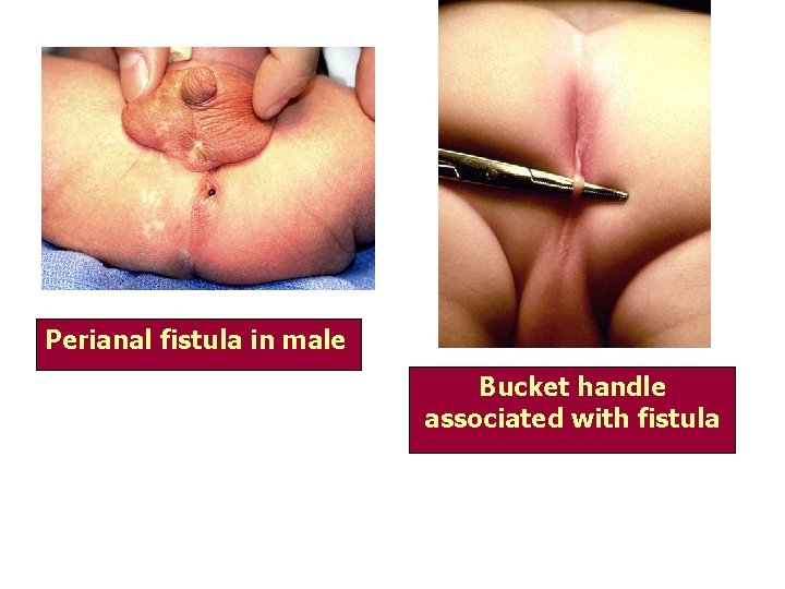 Perianal fistula in male Bucket handle associated with fistula 