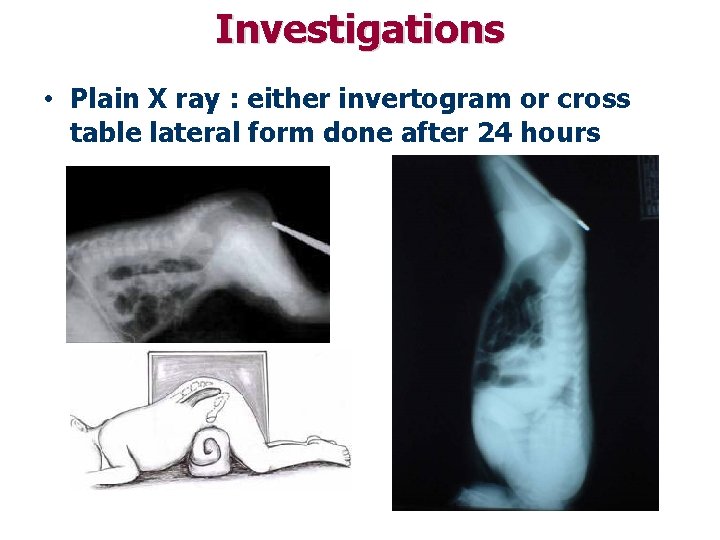 Investigations • Plain X ray : either invertogram or cross table lateral form done