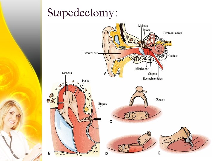 Stapedectomy: 