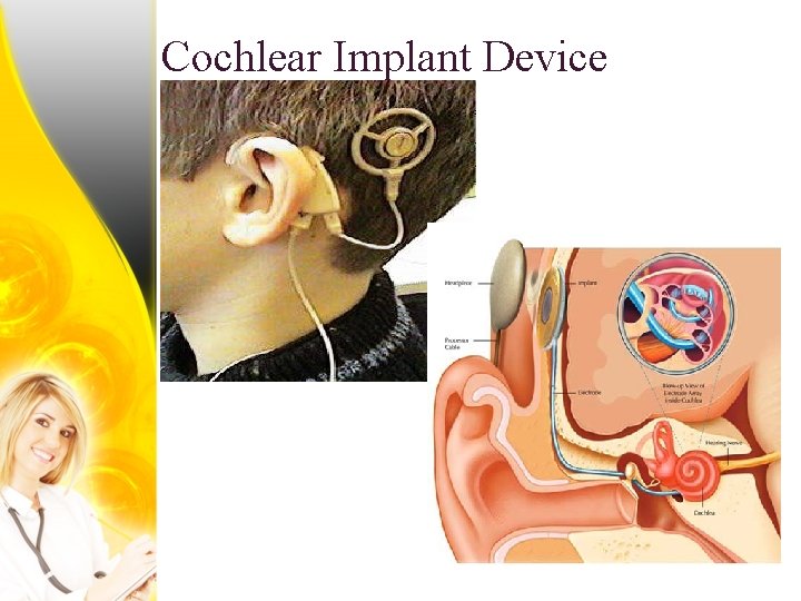 Cochlear Implant Device 