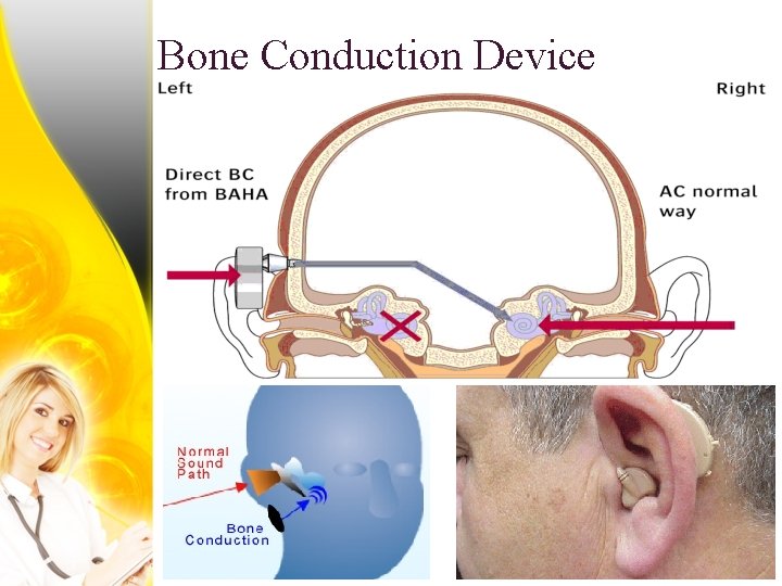 Bone Conduction Device 
