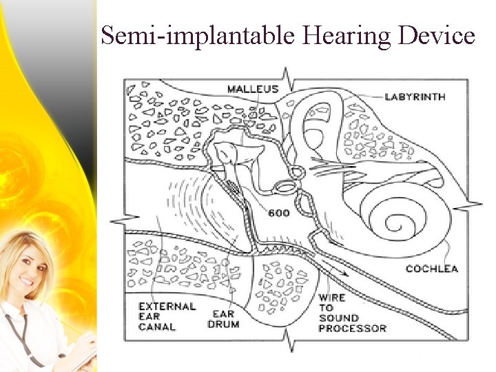 Semi-implantable Hearing Device 