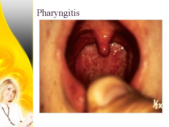 Pharyngitis 