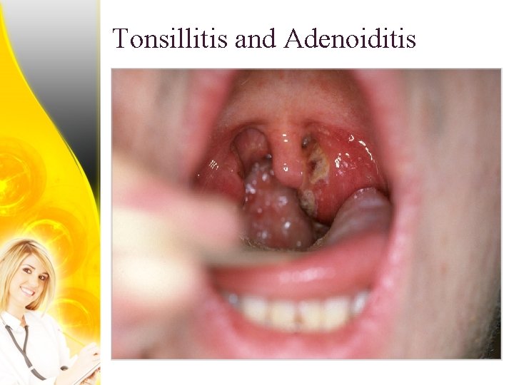 Tonsillitis and Adenoiditis 